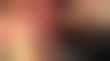 Rectocele CF MESH - Dr.  Ayman Nashashibi - د. أيمن النشاشيبي