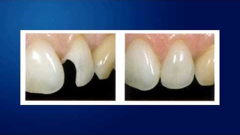 Spearfish Dentists Have Information on Amalgams