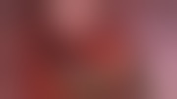 Uniportal VATS right posterior (RS2) segmentectomy