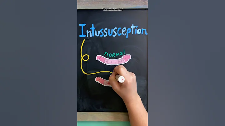 INTUSSUSCEPTION REVIEW