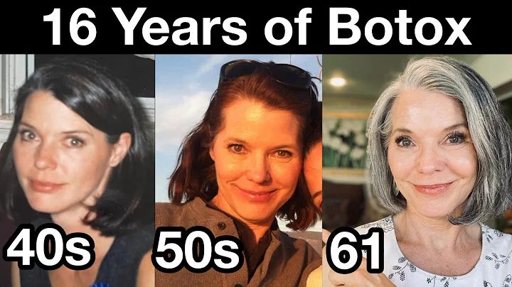 My 16 Year Botox Journey for Preventing Wrinkles | Anti-aging Strategies for 40s, 50s, and 60s