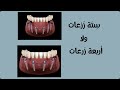 ازاي احدد عدد الزرعات المطلوبة لكل فك ٤ ولا ٦ ولا حتي ٨ زرعات