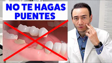 ¿Cuántos dientes puede sustituir un puente?