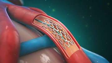 Coronary Artery Intervention - Next Generation Vascular Robotics by Corindus (3d medical animation)