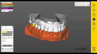 TIZIAN JMA OPTIC by Zebris - Exocad FV Zebris