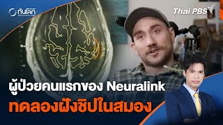 Neuralink เปิดเผยผู้ป่วยคนแรกทดลองฝังชิปในสมอง | ทันโลก กับ Thai PBS | 29 พ.ค. 67