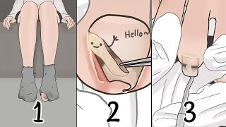 ASMR Satisfying Ingrown toenail removal animation compilation / LULUPANG