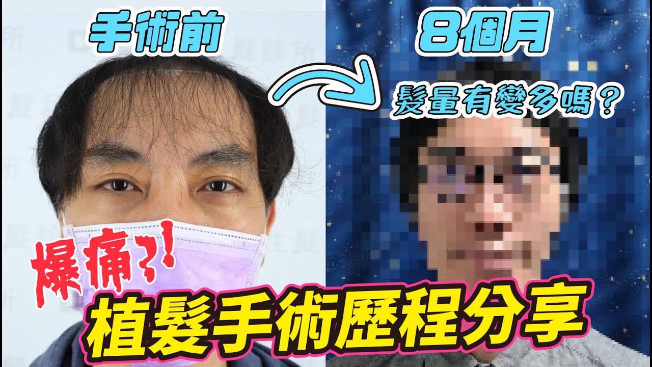 為了 植髮 剃光頭被當流浪漢?｜植髮 8個月的驚人變化?｜完整記錄分享｜《阿珉植髮捐髮紀錄#01》
