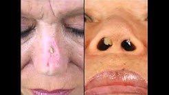 Rhinoplasty San Francisco - Artificial Implants