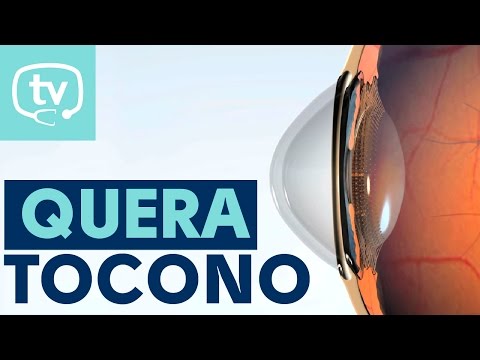 ¿Qué es el queratocono?