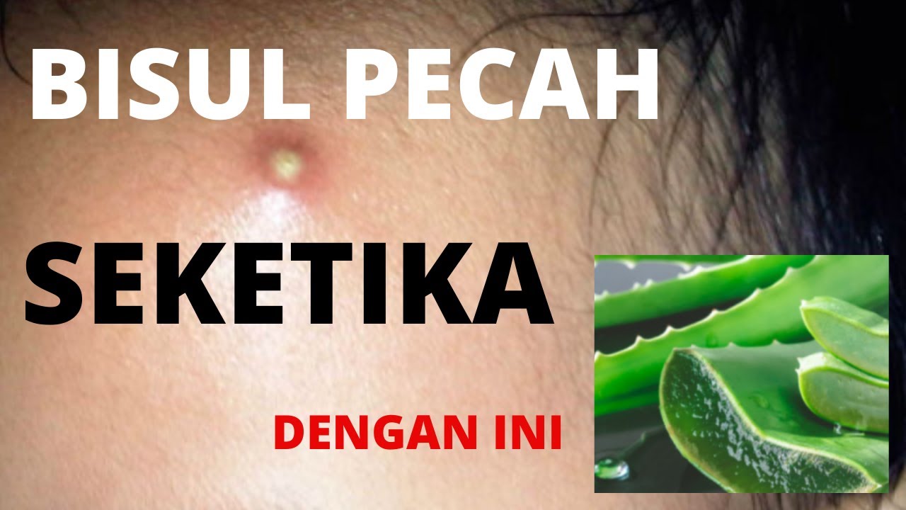 Obat Bisul Paling Ampuh | Manfaat Lidah Buaya | Khasiat Nyata Herbal