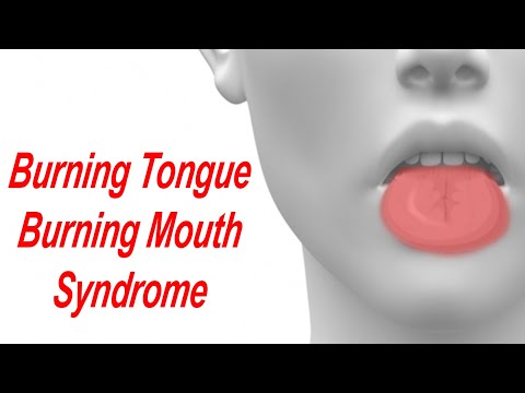 Burning Tongue and Burning Mouth Syndrome: Causes and Treatment