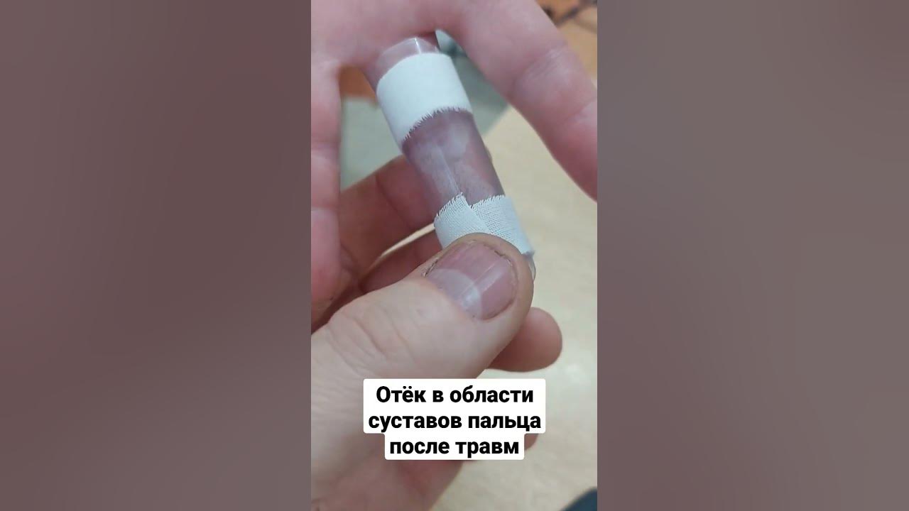 Порваны связки пальца руки. Порваны связки пальца руки