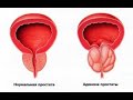 Как предотвратить аденому простаты. Ценные советы для мужчин.
