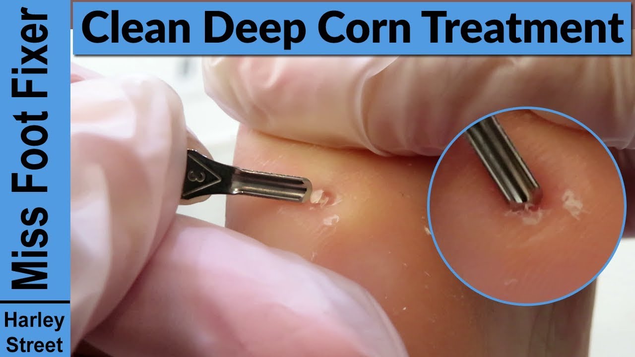 Deep corn removal by podiatrist 