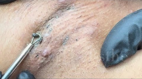 Blackhead Extraction