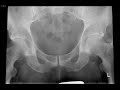 Pelvic Radiograph Part 6