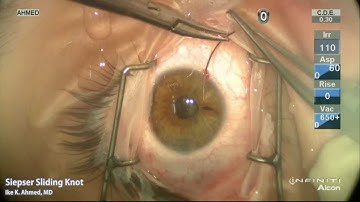 Modified Seipser Sliding Knot for Iris Suturing Ike Ahmed
