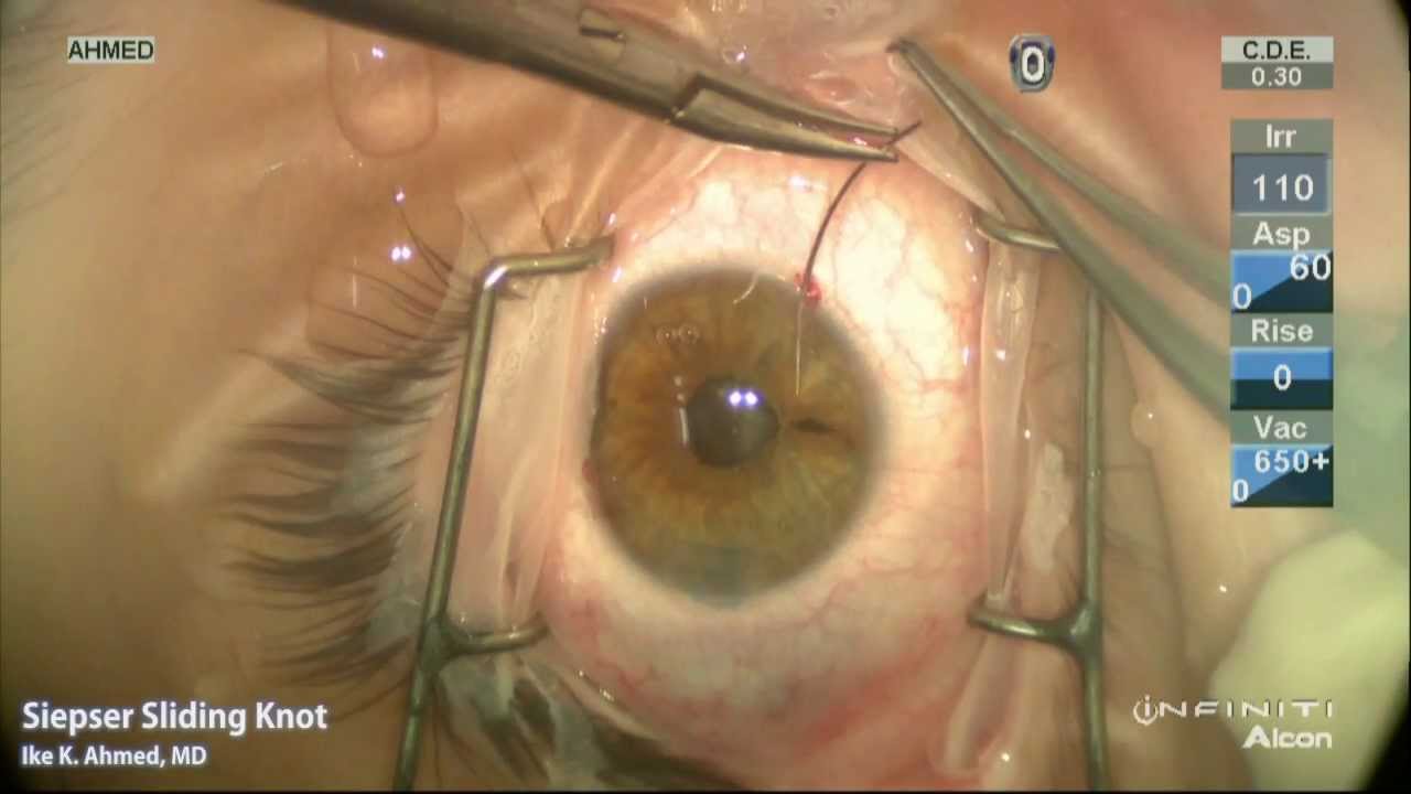 Laparoscopic Renal Cyst Ablation - UF Health