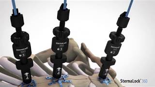 SternaLock 360 Animation