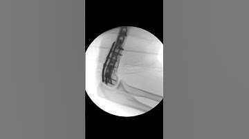 Distal Humerus Fracture #ortho #trauma #science #education #humerus #fracture