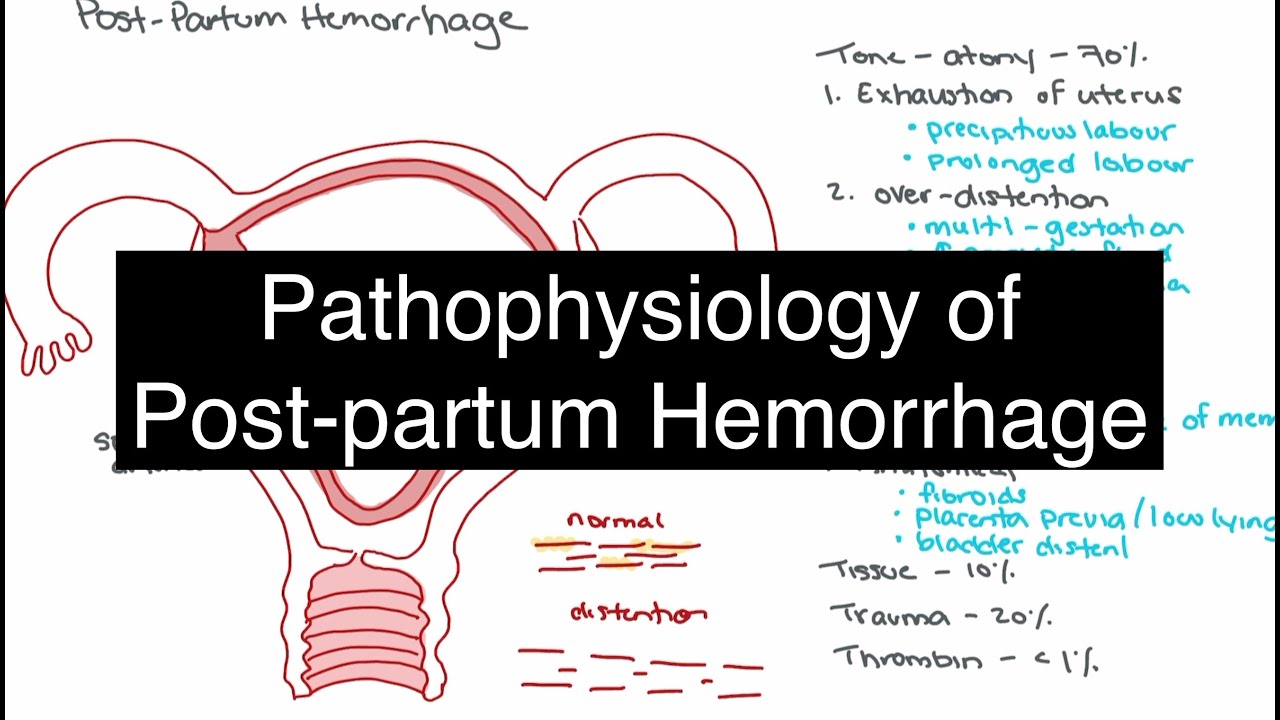 Pathophysiology Of Postpartum Hemorrhage YouTube