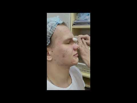 Криомассаж кожи лица