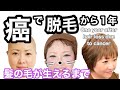 【抗がん剤副作用で脱毛】から髪の毛が生えるまで　卵巣がんさくら　One year after hair loss due to cancer