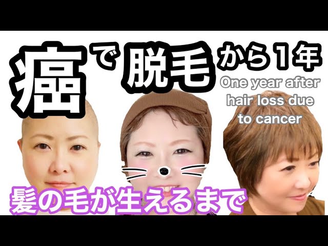 抗がん剤治療後 脱毛から髪の毛が生えるまで 卵巣がん患者 One Year After Hair Loss Due To Cancer Youtube