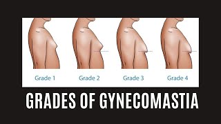 There Are 4 Grades Of Gynecomastia. What Are They? How To Treat Them.