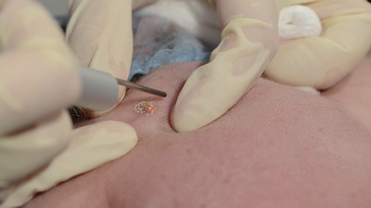 Удаление кератомы на лице лазерным методом