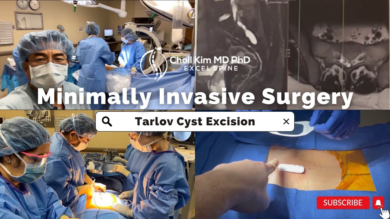 Tarlov Cyst Excision - YouTube