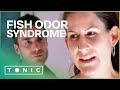 What is it like to live with fish odor syndrome bad breath syndrome  the food hospital  tonic