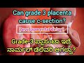 Grade lll placenta &amp; developmental delay #pregnancy #tips #pregnant #infertility #kannada #baby#info