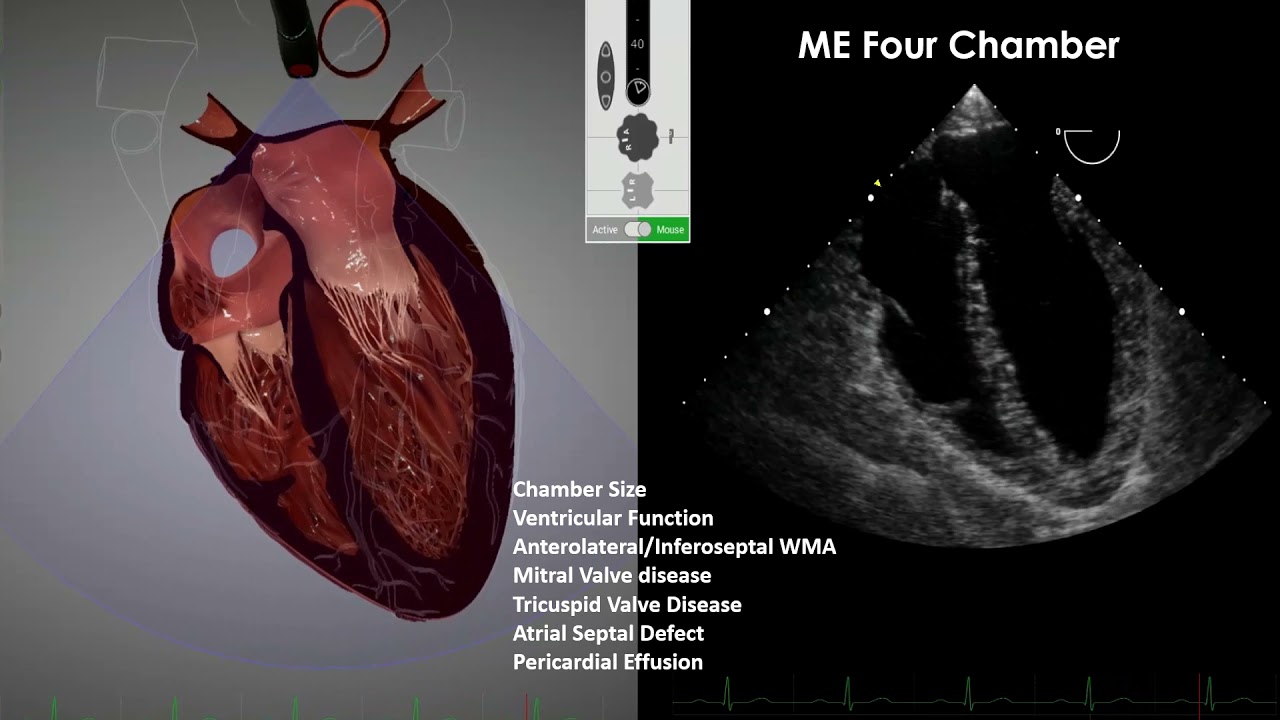 健康+医学 Transesophageal Echocardiography Transesophageal echocardiogram mid-esophageal view at 120