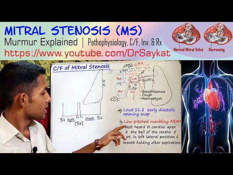 Mitral Stenosis (MS) | Pathophysiology | Murmur | Clinical Features | Treatment | Dr. Saykat