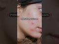 Best cream for Pimples and acne #shorts