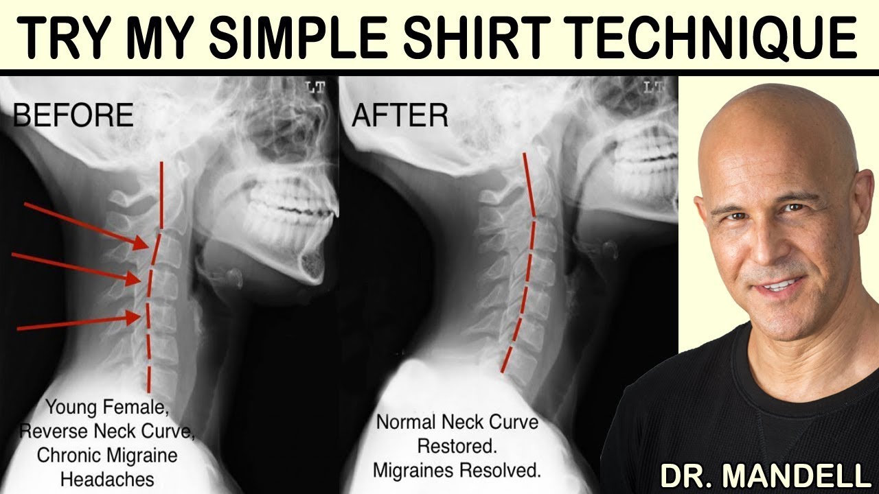 The type of cervical curvature according to the lateral cervical spine