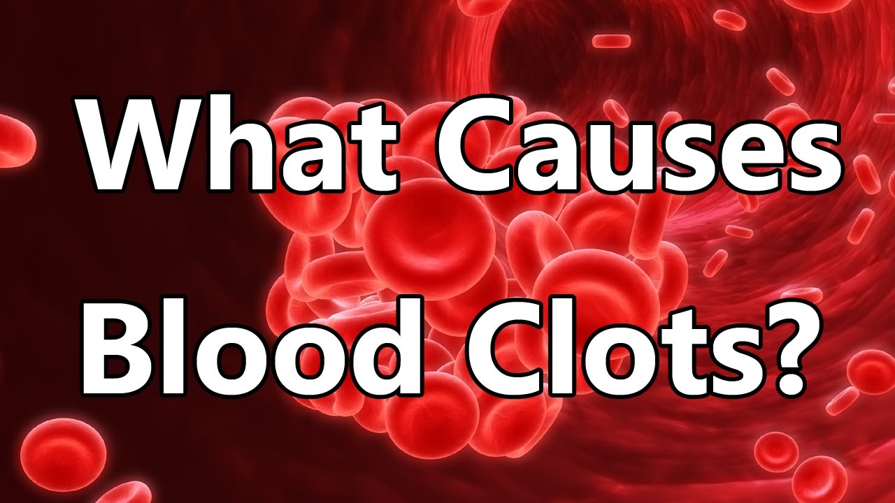 What Causes Blood Clots? YouTube