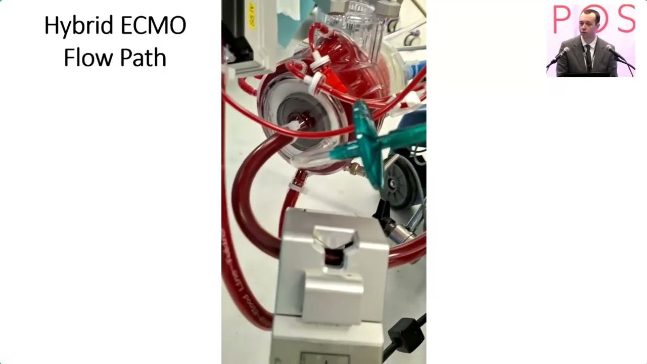 Karl Riley Mobility The Wythenshawe Hybrid Circuit: A Novel Technique for Lung ...