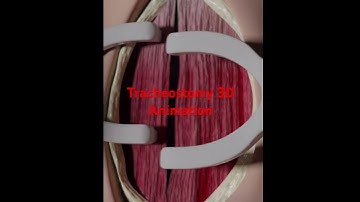 Tracheostomy 3D Animation#tracheostomy#medical animation