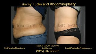 Mini Tummy Tuck Video (Mini Abdominoplasty) - SF Bay Area - 27 