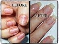 My Nail Journey-Growing Natural Nails after damage from Acrylics/Gels