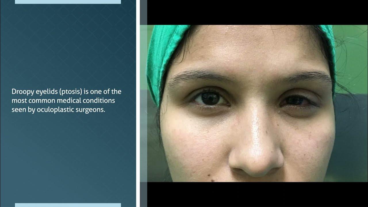 Ptosis латынь. Ptosis латынь