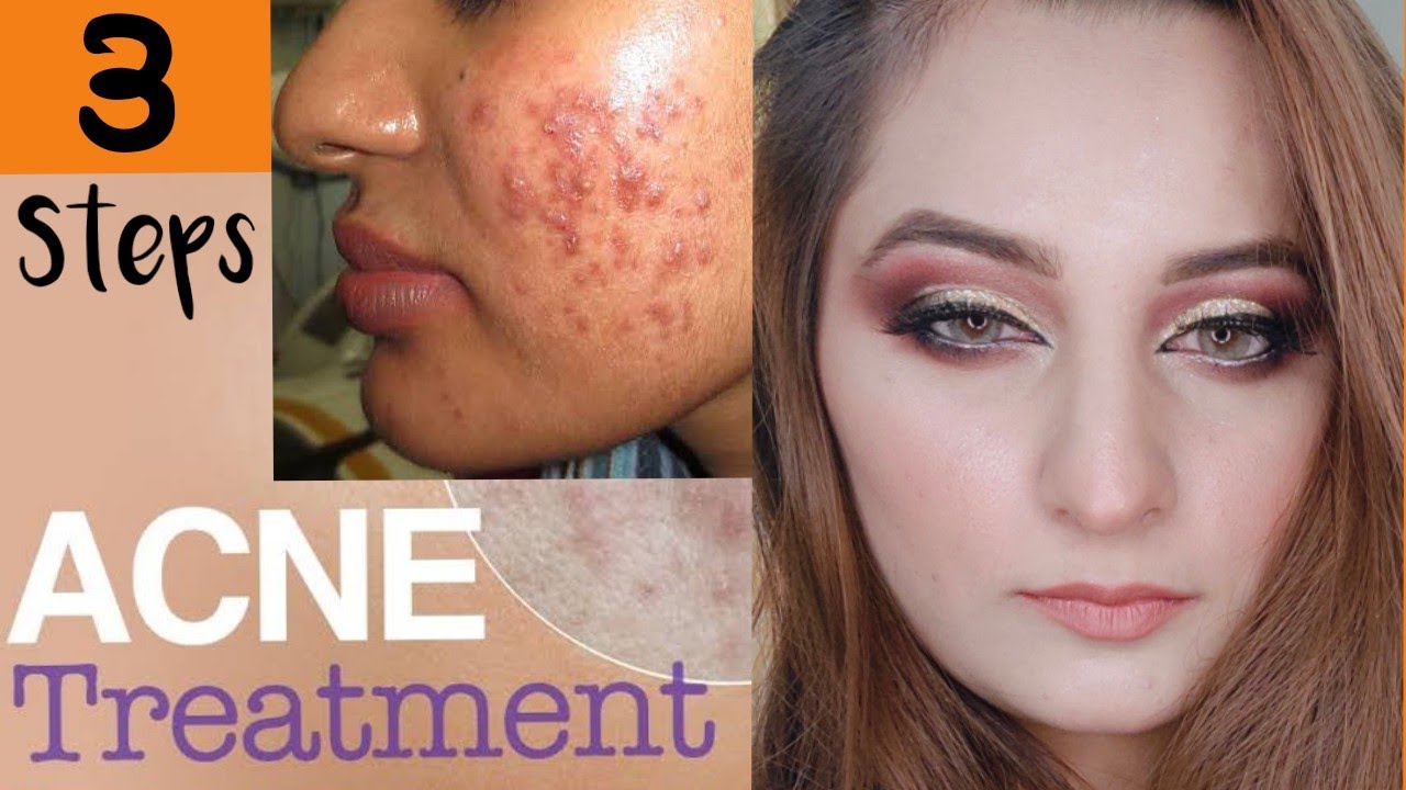 Acne Treatment at Home | Best remedy for pimples - YouTube