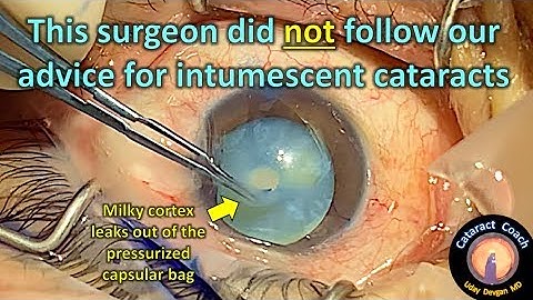 Milky fluid leaks out of the intumescent cataract (dense white cataract surgery)