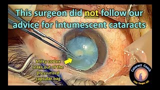 Milky fluid leaks out of the intumescent cataract (dense white cataract surgery)