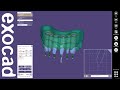 exocad Video Tutorial: Model Creator