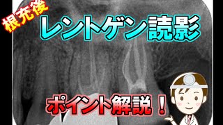 【歯医者向け】根充後のレントゲン読影を解説！