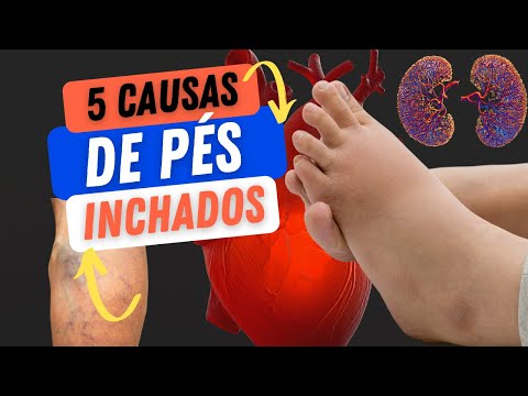 5 causas de pés inchados.